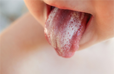 [Translate to English-GB:] Tongue of a toddler with white plaque